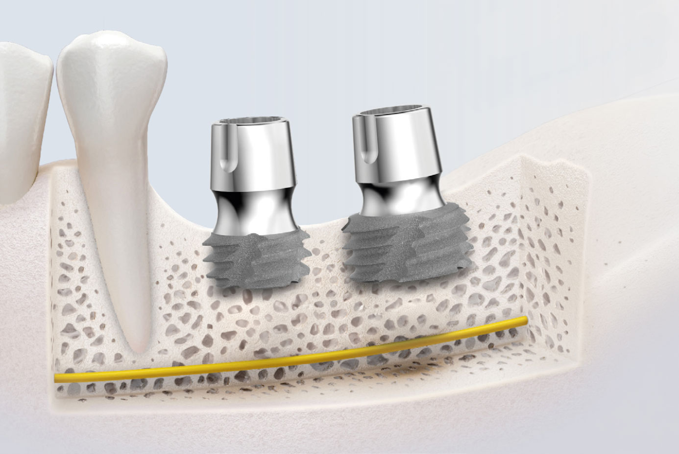 Impianto dentale Nano Short