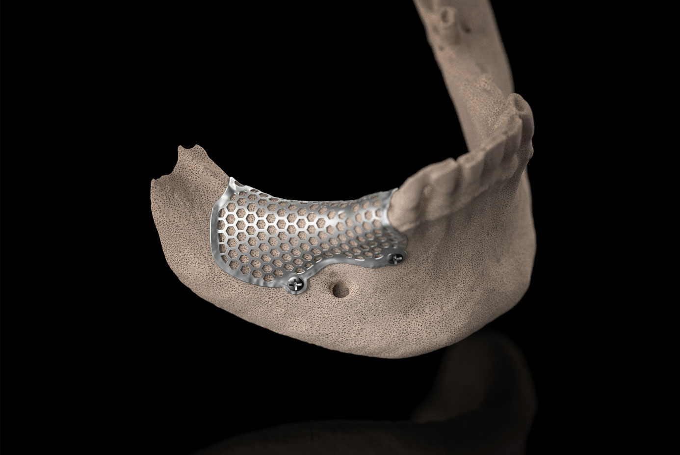 3D-Mesh custom di BTK
