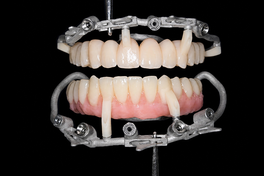 cerature su modello implantare per realizzazione guide Puzzle Guide