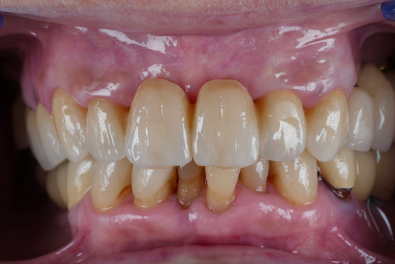 Risultato finale del settore anteriore superiore mediante ponte in zirconia Lunaris microstratificato con VITA Lumex AC