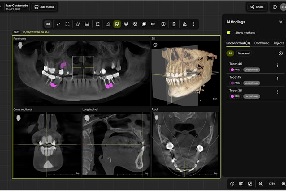 Smart View - Detect: l'IA di Denstsply Sirona a supporto della revisione CBCT