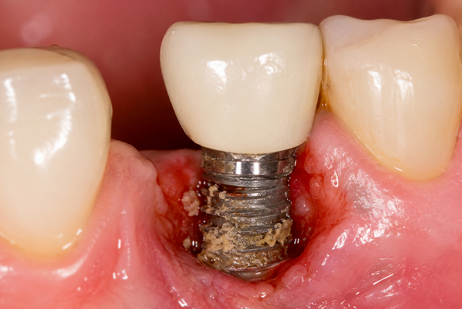 Perimplantite: quali trattamenti chirurgici o non chirurgici funzionano davvero?