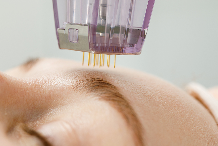 Microneedling in MEO