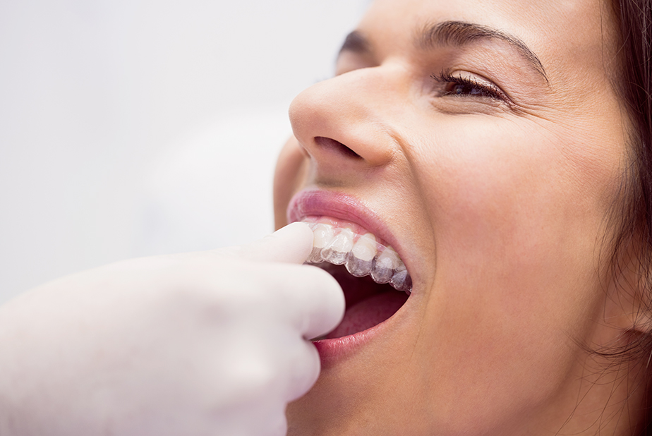 Sbiancamento dentale con allineatori trasparenti: vantaggi e risultati