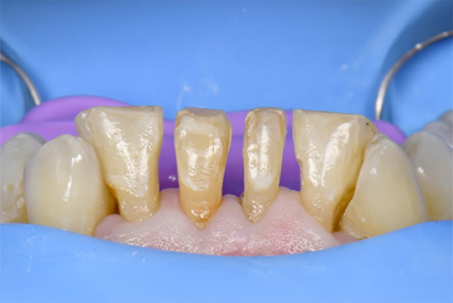 Tecnica Injection Molding per faccette dirette con Solventum™ Filtek™ Easy Match Flowable Restorative