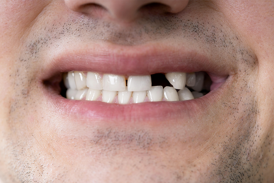 Denti che rispuntano dopo i quaranta? La ricerca ci si sta avvicinando