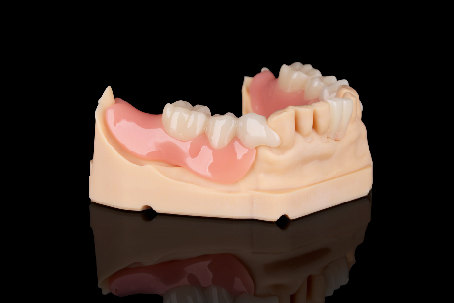 Flexmon Partials. Protesi parziali di nuova generazione prive di metallo