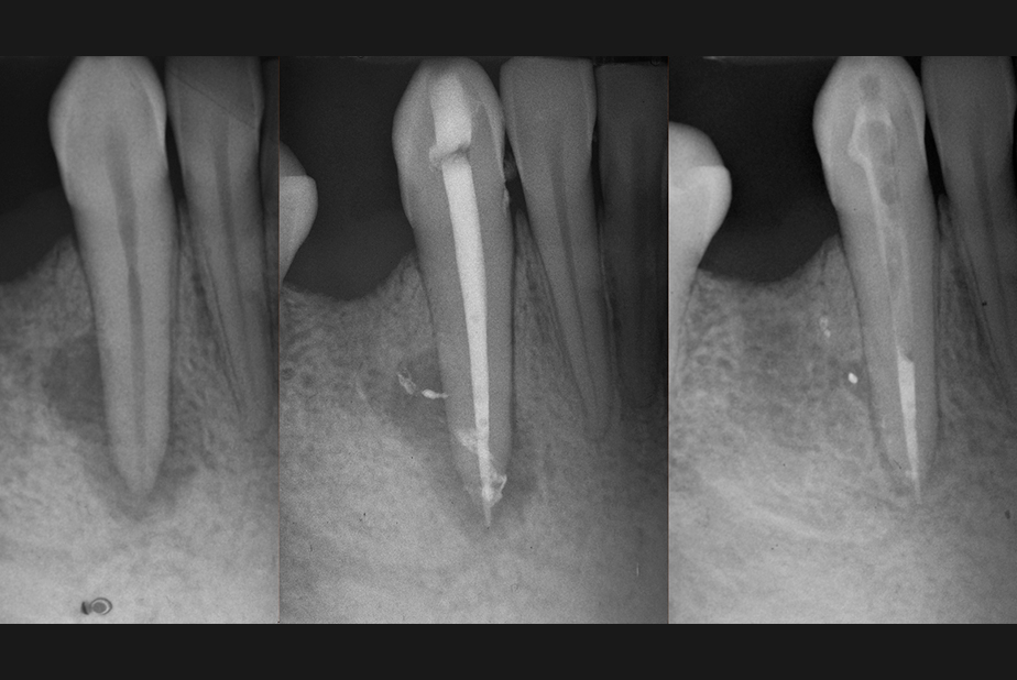 Endodonzia clinica: un percorso pratico dalla diagnosi alla gestione del caso