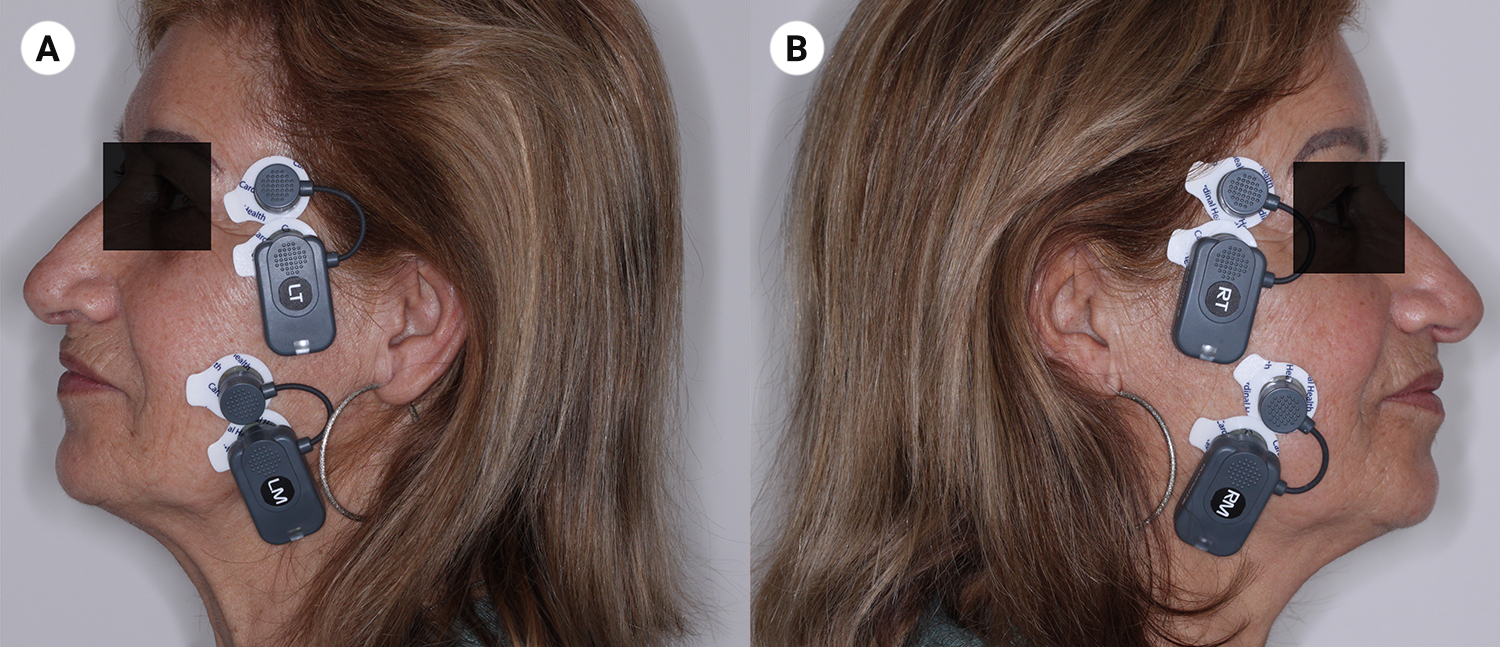 Fig. 3. Foto laterale sinistra (a) e foto laterale destra (b) degli elettrodi posizionati sul viso della paziente in corrispondenza dei muscoli masseteri e mandibolari.