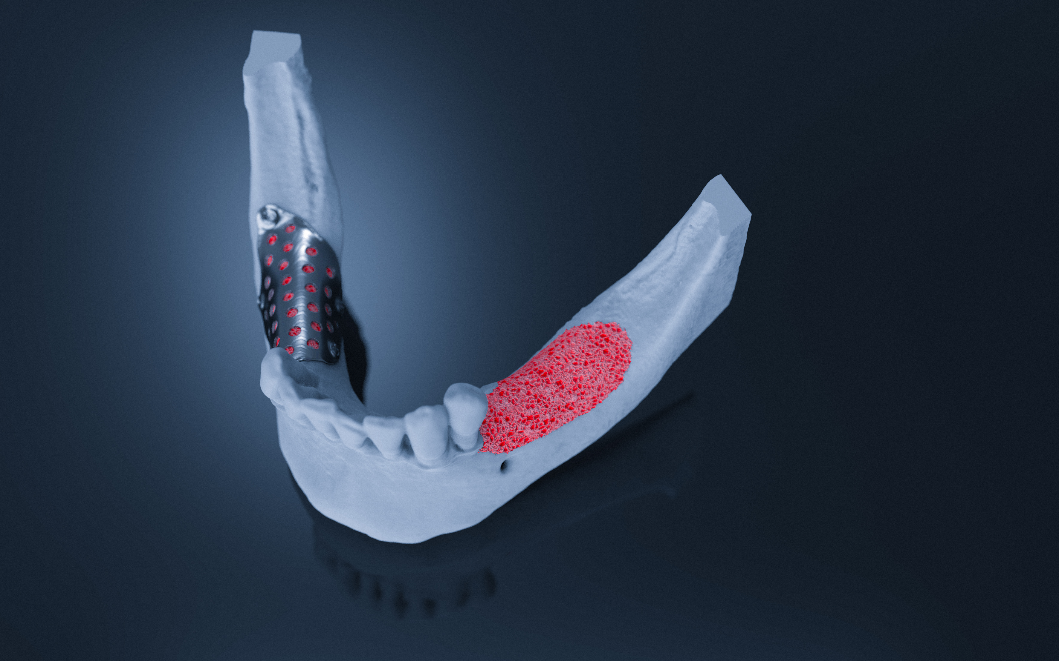 3D-Mesh BTK