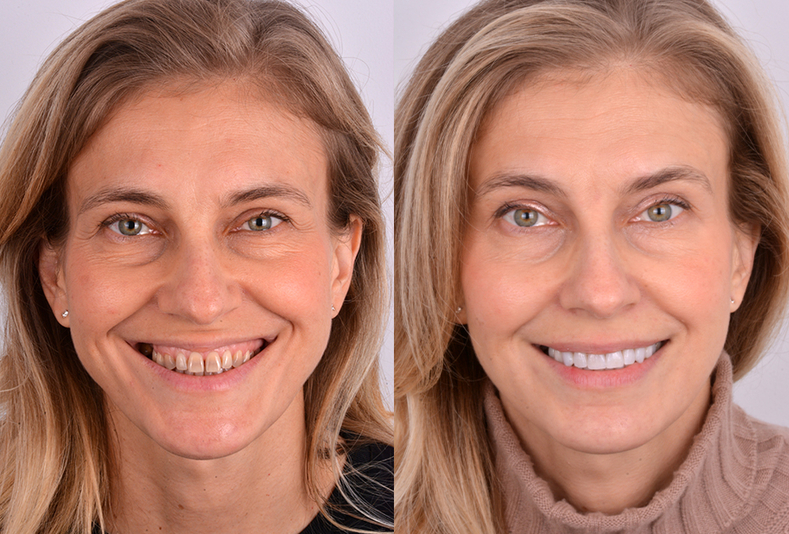 Prima e dopo Metodo Re-smiling