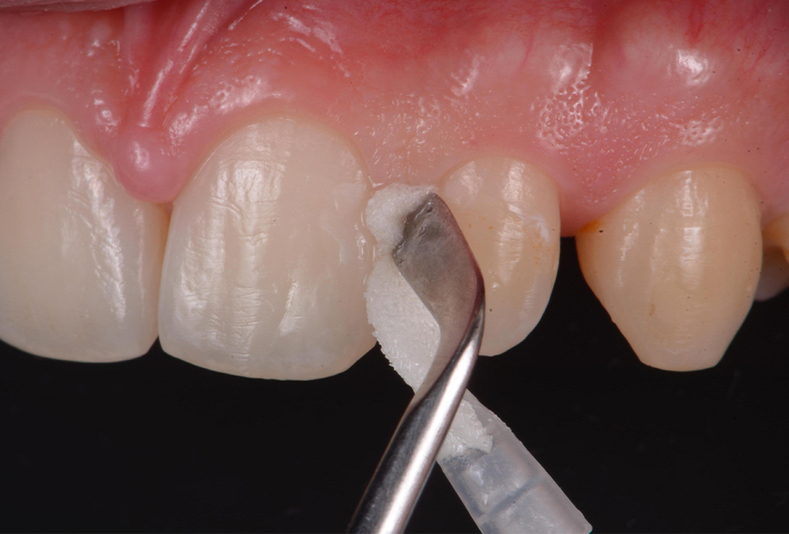 applicazione CURODONT™ REPAIR