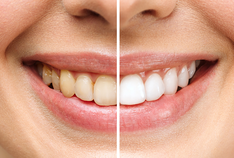 Primo piano del sorriso di una ragazza diviso a metà, una metà ha un colore di denti più gialli, l'altra metà li ha più bianchi