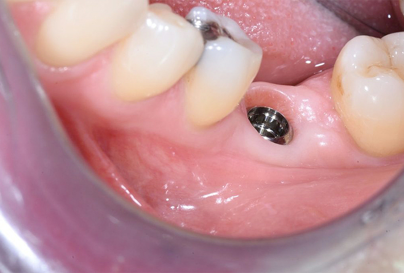 Primo piano di denti di una bocca 