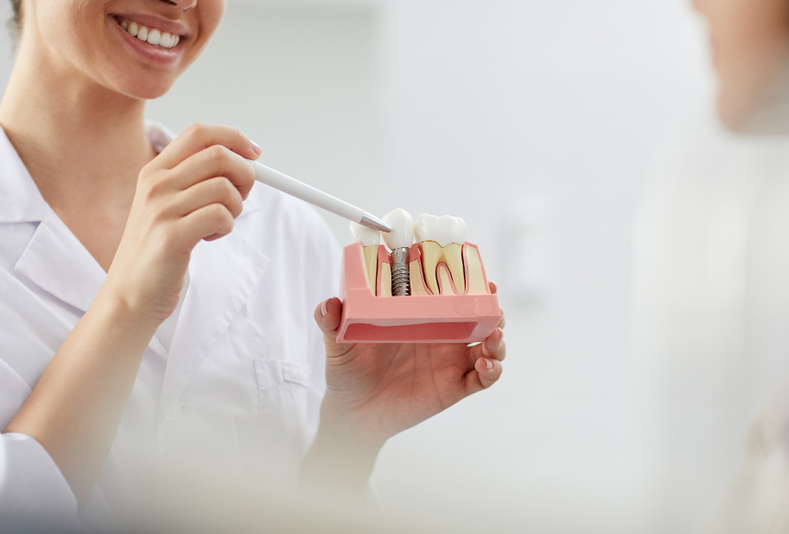 modello di impianto dentale