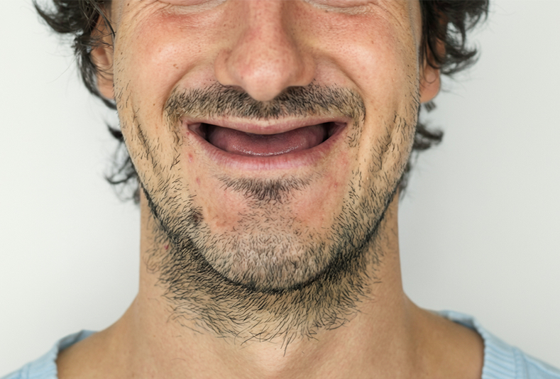 primo piano di bocca di un uomo con edentulia
