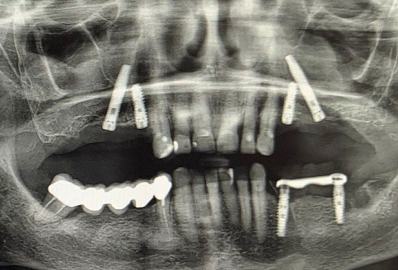 Riabilitazione del mascellare superiore con approccio implantare combinato: impianti convenzionali e transinusali 