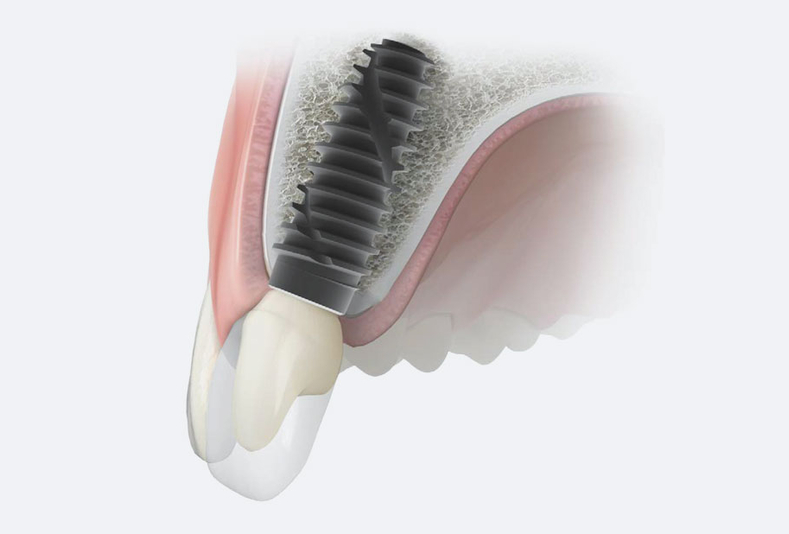 Linea implantare IS+