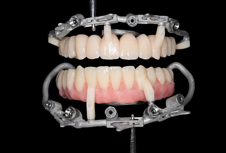 cerature su modello implantare per realizzazione guide Puzzle Guide