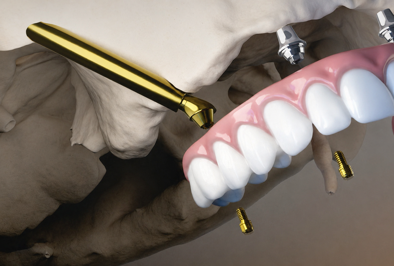 ProZygoma di BioHorizons