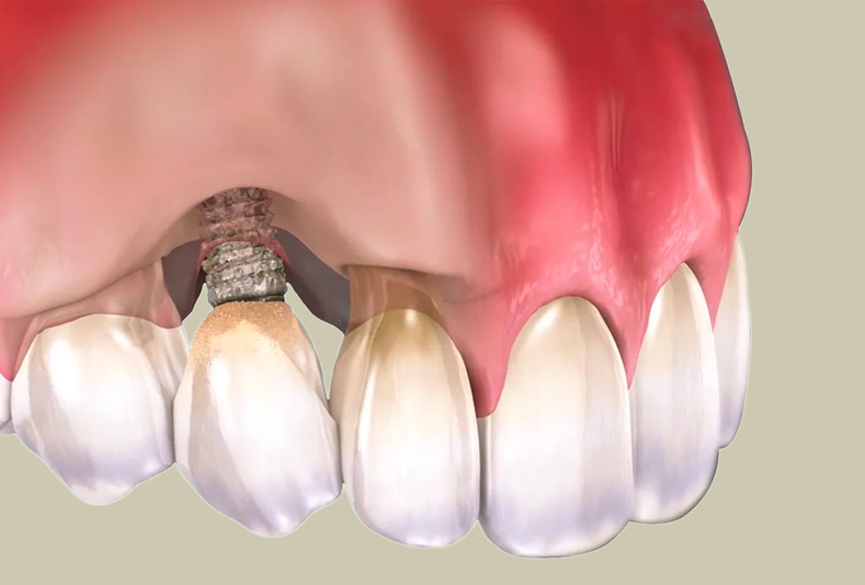 Peri-implantite