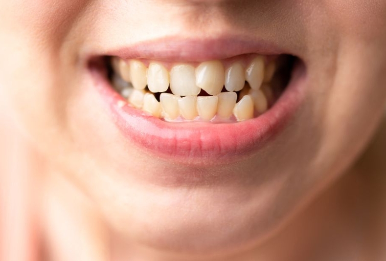 affollamento dentale