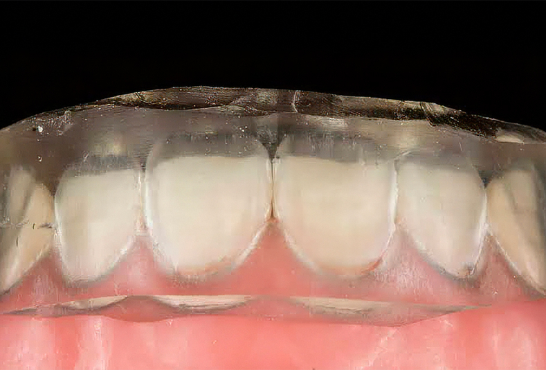 Primo piano di allineatore trasparente inserito su arcata dentale