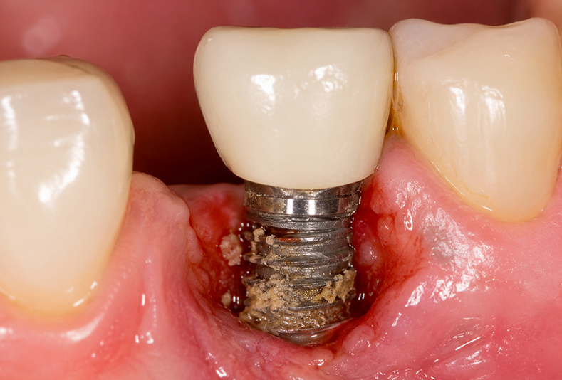 Perimplantite