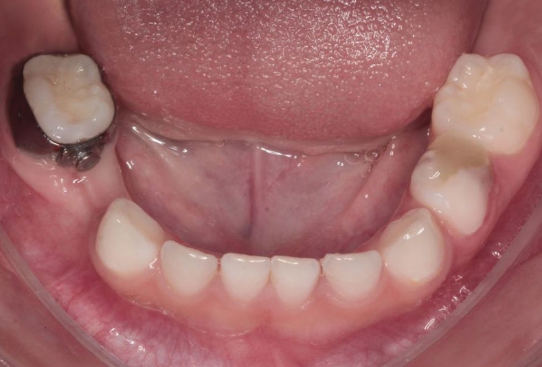 Mantenitori di spazio pediatrici: una tecnica analogica per recuperare funzione ed estetica