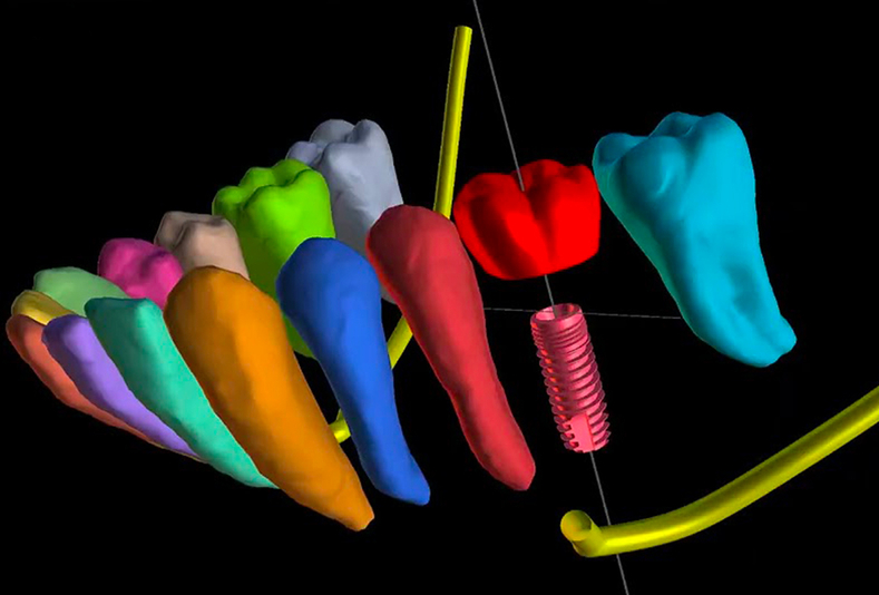 Software di pianificazione implantare
