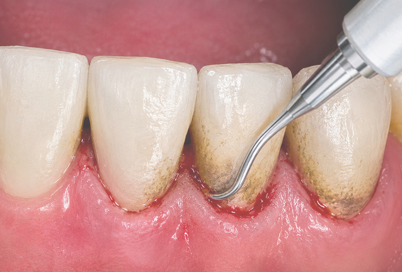 debridement sottogengivale