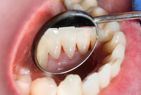 bocca aperta con parodontite