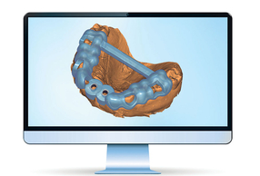 Innovazione ed eccellenza nella pianificazione implantare e nella chirurgia guidata Exoplan