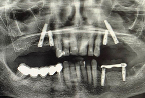 Riabilitazione del mascellare superiore con approccio implantare combinato: impianti convenzionali e transinusali 