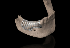 3D-Mesh custom di BTK