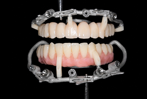 cerature su modello implantare per realizzazione guide Puzzle Guide