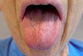 paziente con xerostomia