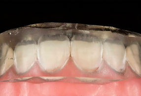 Primo piano di allineatore trasparente inserito su arcata dentale