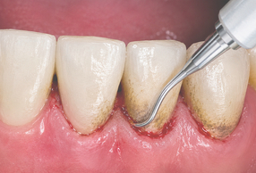 debridement sottogengivale