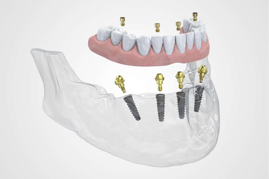 Neoss® Group annuncia il lancio del Multi-Unit Abutment