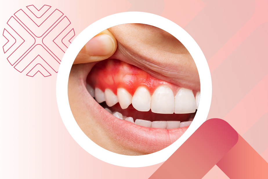 Expodental Meeting 2024: un progetto dedicato alla parodontologia parodontite