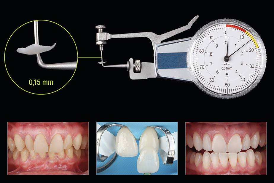 Trattamento mininvasivo con faccette in zirconia Prettau Skin: il flusso di lavoro completo faccette in zirconia Prettau Skin