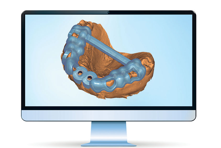 Innovazione ed eccellenza nella pianificazione implantare e nella chirurgia guidata Exoplan