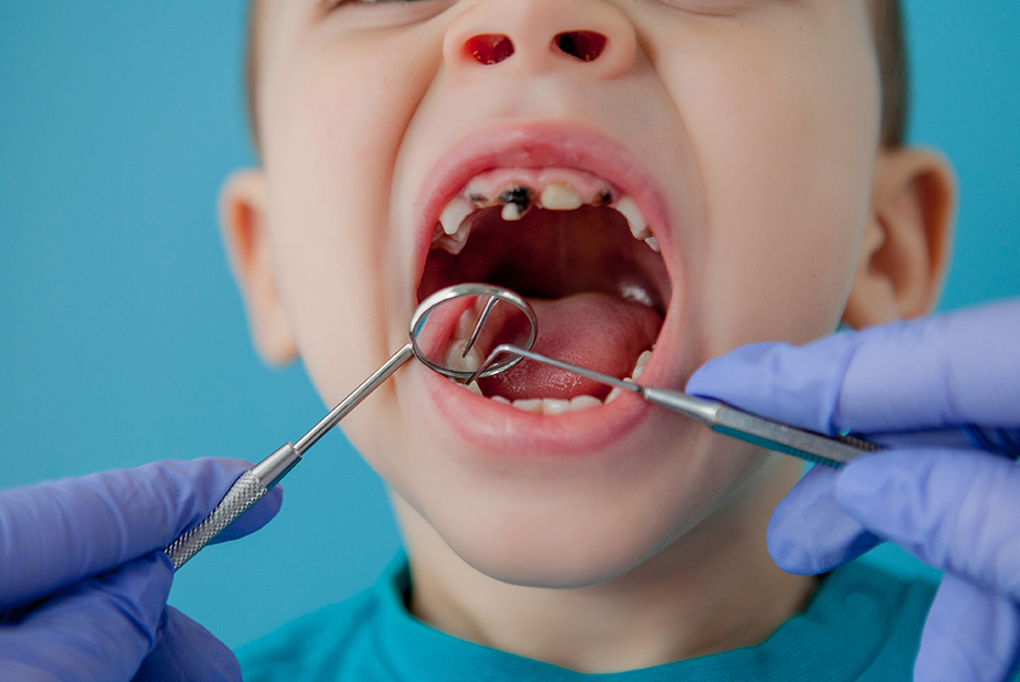 Gestione odontoiatrica di un paziente pediatrico con ittiosi congenita paziente pediatrico con ittiosi