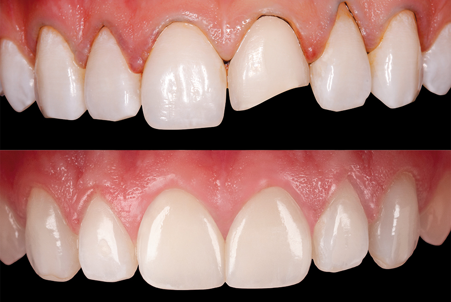 Prettau Skin: le faccette ultrasottili che rivoluzionano l'odontoiatria mininvasiva Prima e dopo l'utilizzo delle faccette Prettau Skin di Zirkonzahn