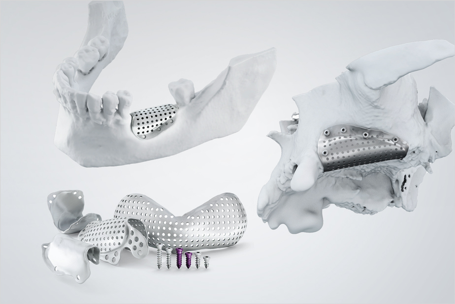 3D-Mesh BTK