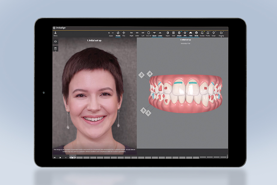 Align Technology rivoluziona la pianificazione dei trattamenti Align ClinCheck