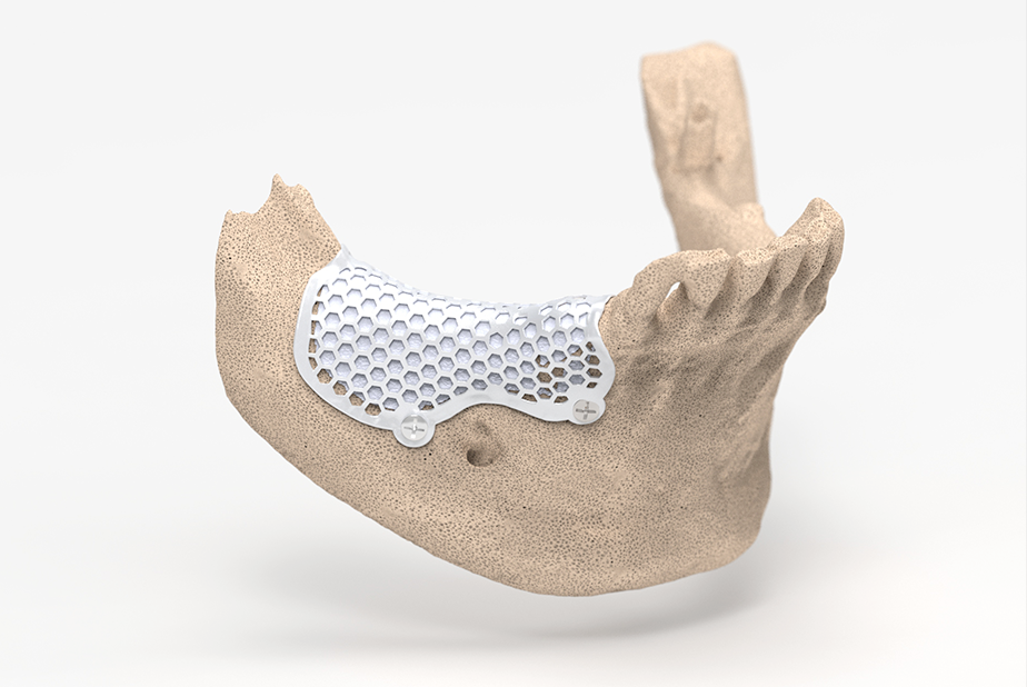 GBR più efficiente e predicibile con la 3D-Mesh Custom di BTK 3D-Mesh Custom di BTK