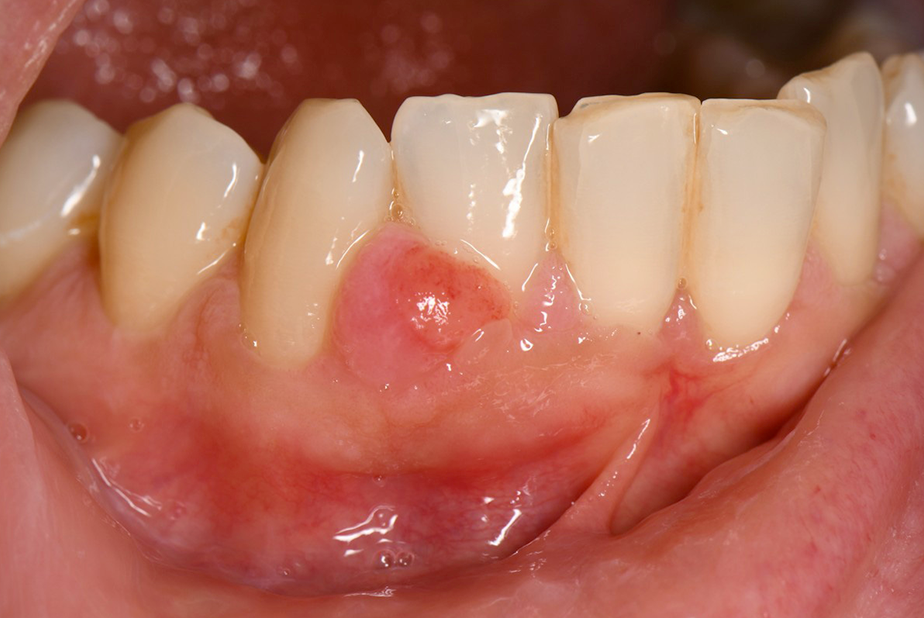 granuloma piogeno in zona 4.2, 4.3