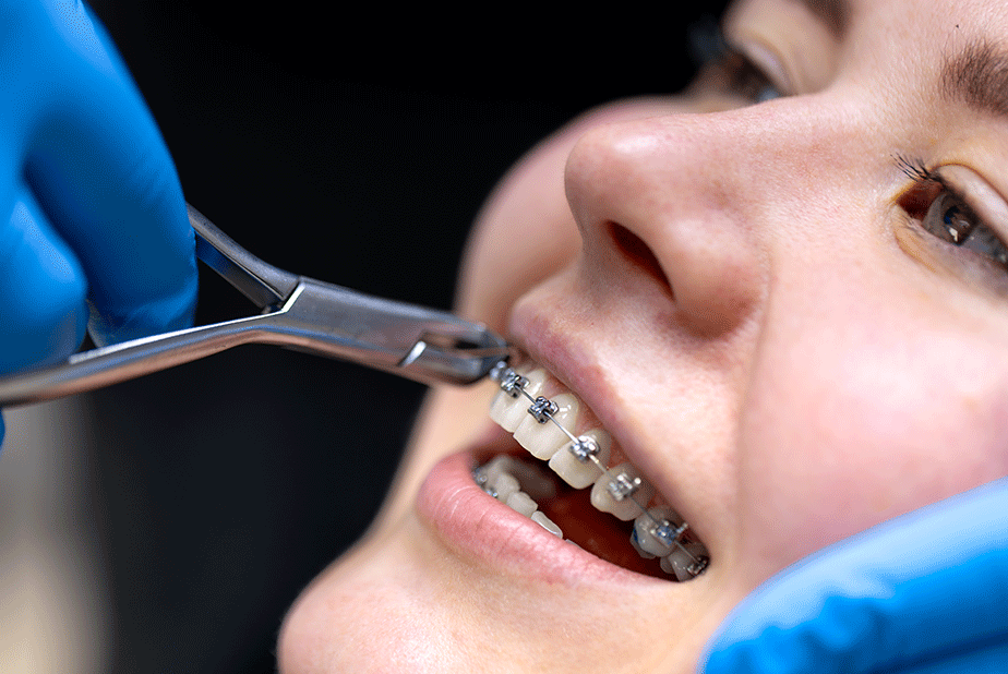 Rimozione degli attacchi ortodontici: proteggere lo smalto dentale Primo piano di una ragazza dal dentista mentre le viene tolgo l'attacco ortodontico
